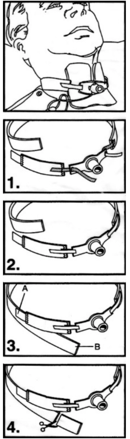2miil fixation cannulas and vias fixation tapes for tracheostomy cannulas model fi 165 use